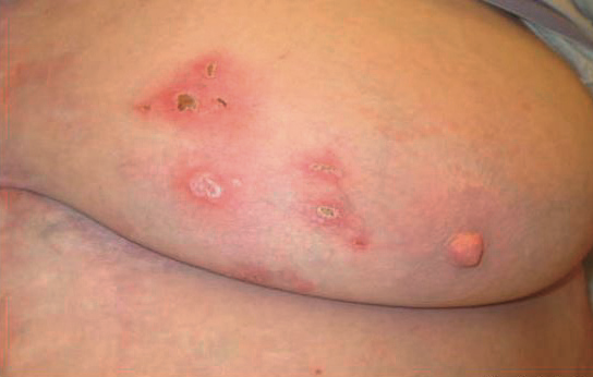 Hidradenitis Supurativa Inframamaria tratamiento médico