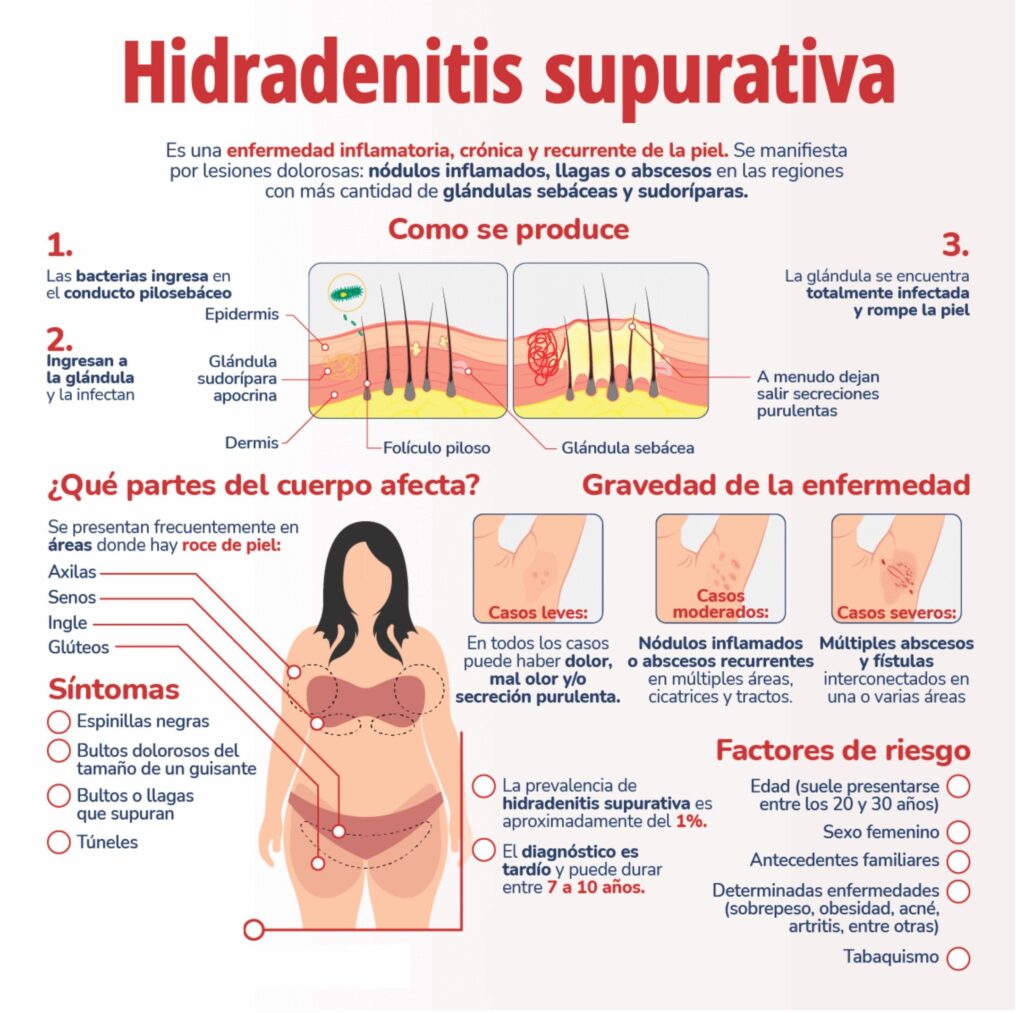 hidradenitis supurativa mamaria tratamiento láser