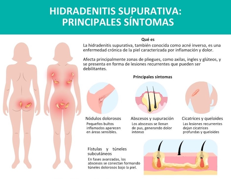 hidradenitis supurativa en las nalgas