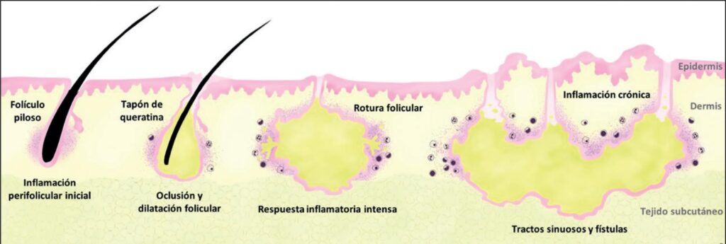 hidradenitis supurativa retroauricular tratamiento láser