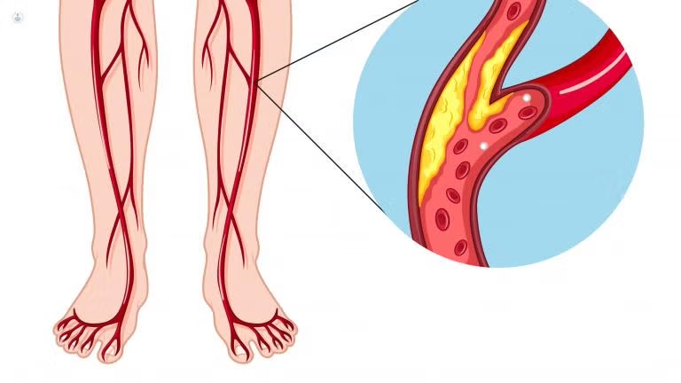 insuficiencia arterial. médico angiólogo