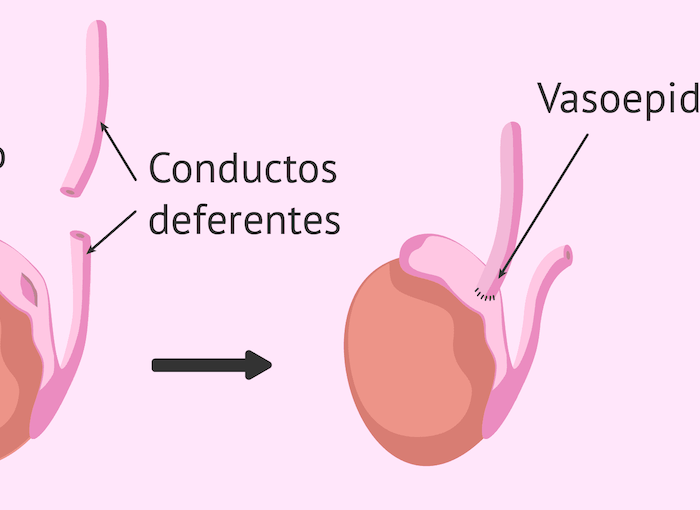 Vasoepididimostomía microcirugía ambulatoria
