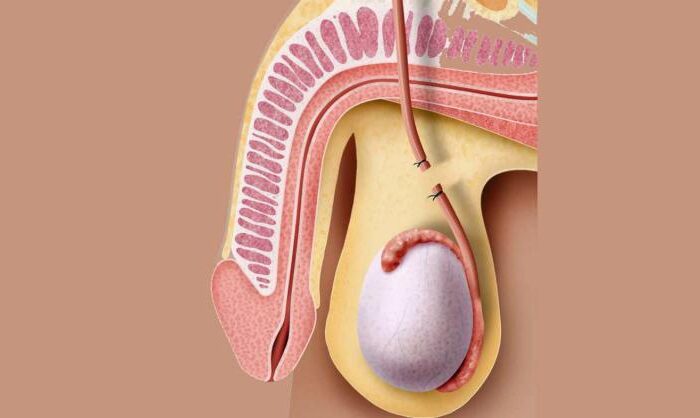 reversión de vasectomía con microcirugía
