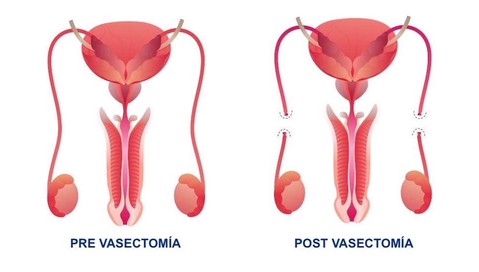 vasectomía ambulatoria
