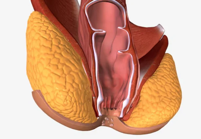 Cauterización de condilomas anales (por VPH) de urgencia