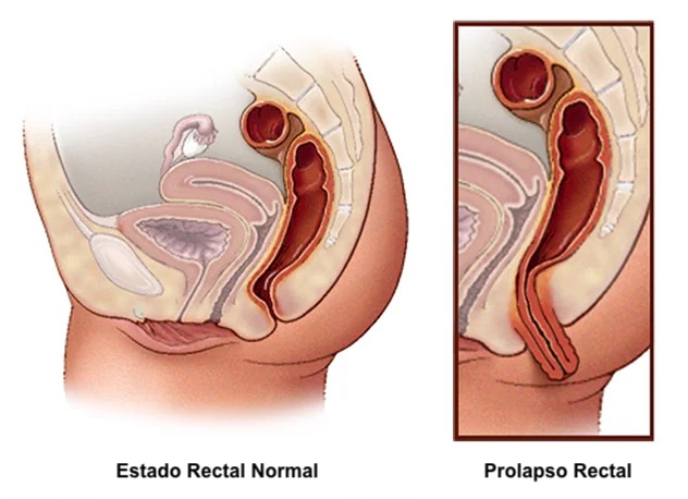 Cirugía menor de prolapso mucoso rectal en santiago