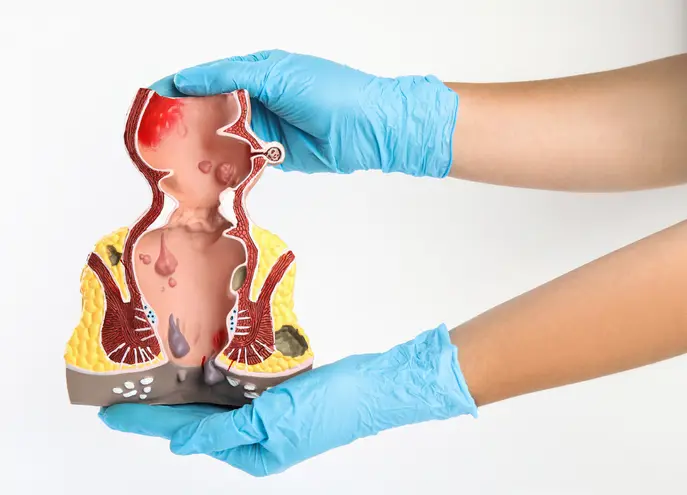 Estenosis Anorrectal Severa urgente