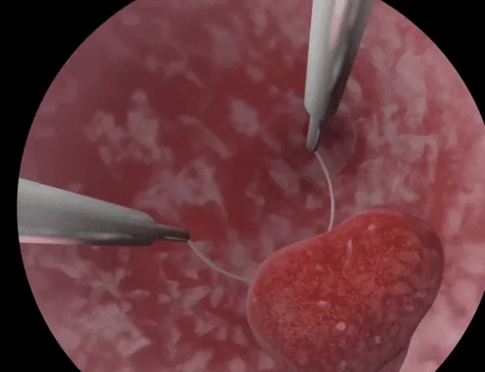 Biopsia Dirigida del Endometrio con histeroscopio