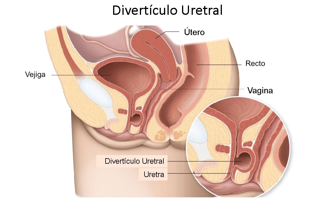 Divertículos Uretrales diagnóstico con cistoscopio