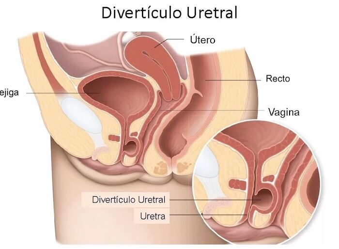 Diverticulos Uretrales atención médica urgente