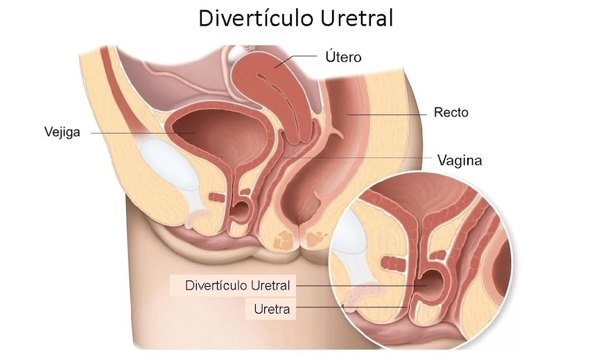 Diverticulos Uretrales atención médica urgente