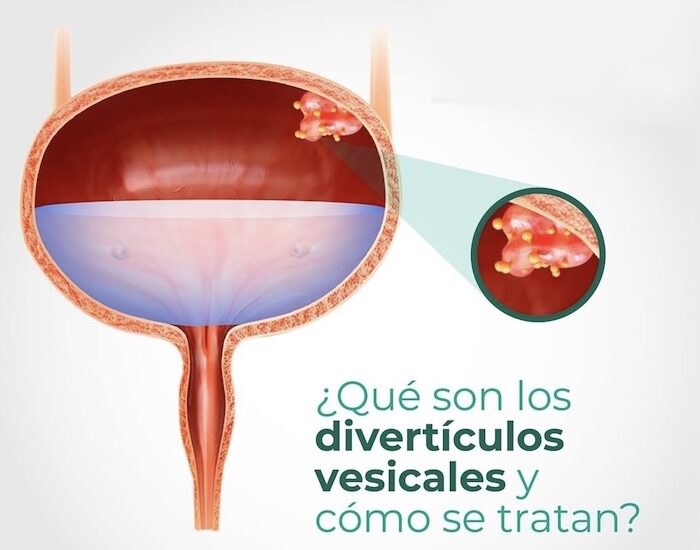 Divertículos Vesicales médico especialista