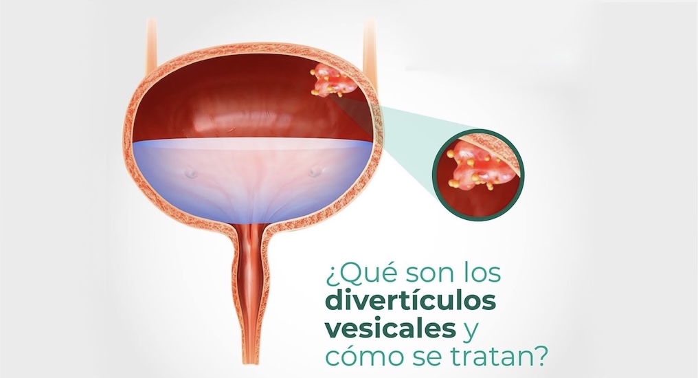 Divertículos Vesicales médico especialista