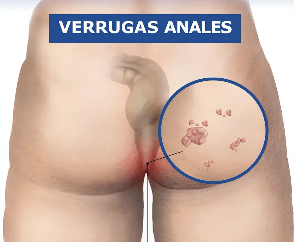Exceresis de Papilomas Anorrectales en santiago