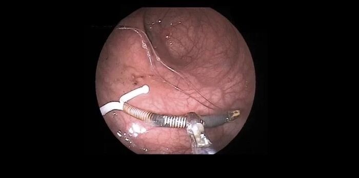 Extraccion de diu de urgencia