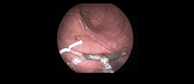 Extraccion de diu de urgencia