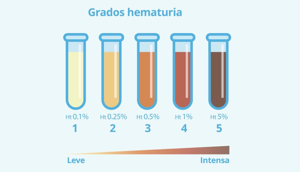 sangre en orina tratamiento médico