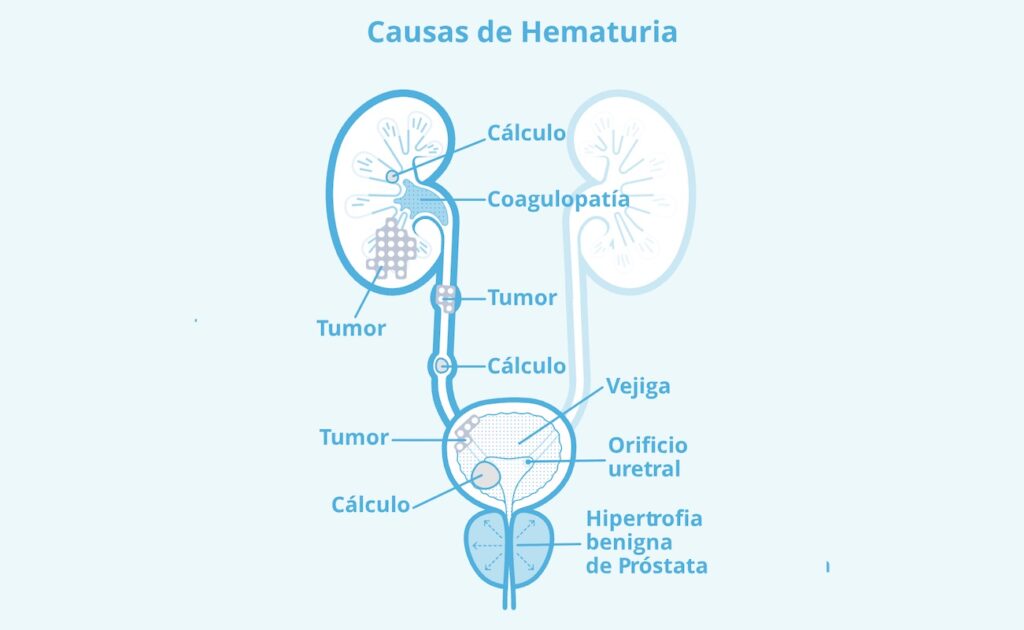 Hematuria y cistoscopía en santiago