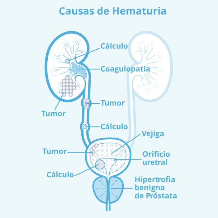 Hematuria y cistoscopía en santiago