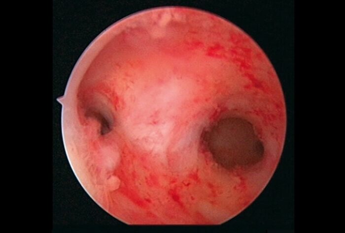 Lisis de sinequias con histeroscopía