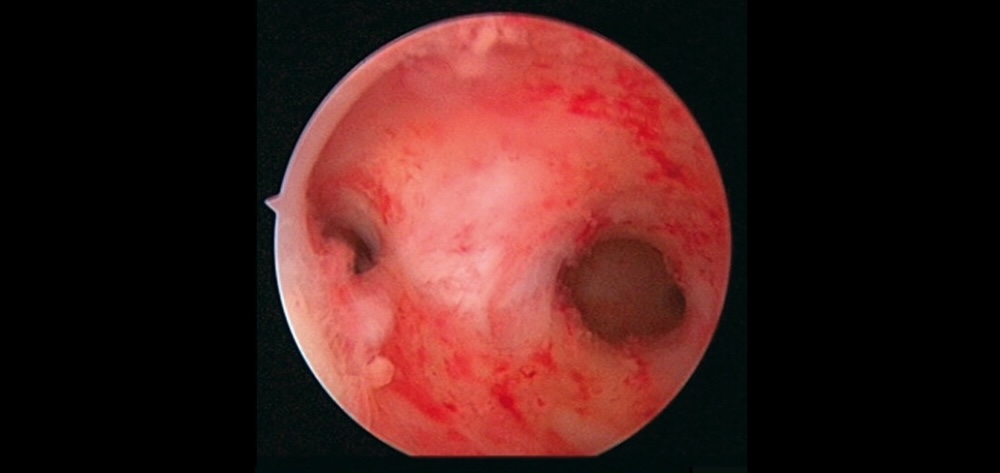 Lisis de sinequias con histeroscopía