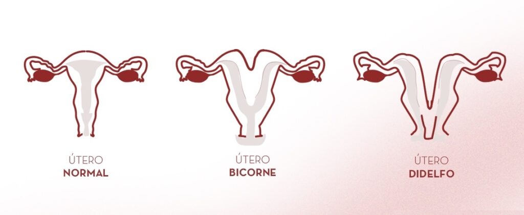 Malformaciones Uterinas diagnóstico y tratamiento