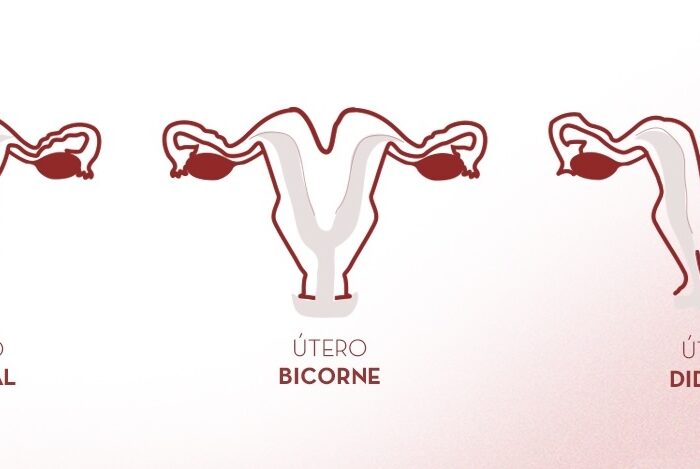 Malformaciones Uterinas diagnóstico y tratamiento