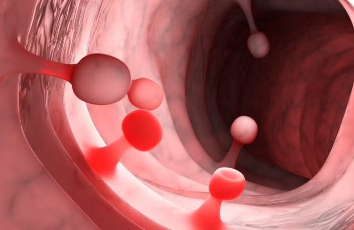 Resección de Pólipos Endometriales con histeroscopía