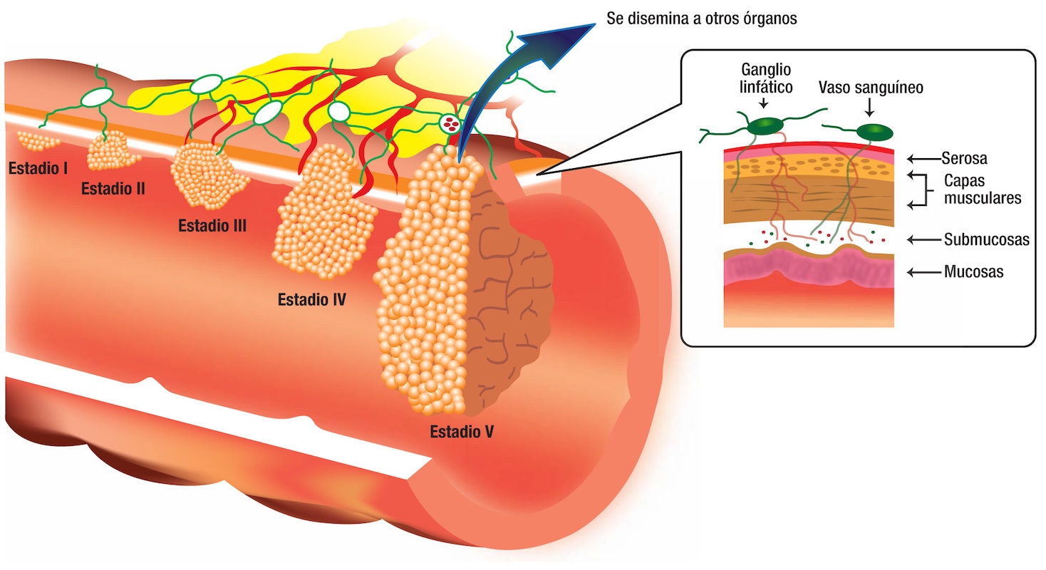 Resección de Tumores Anorrectales en santiago