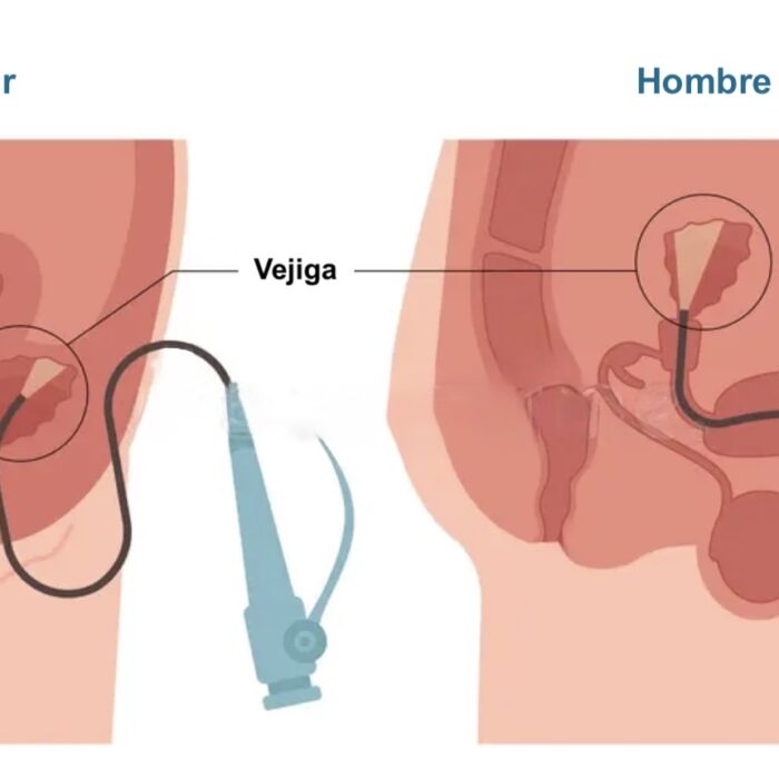 cistoscopía flexible de urgencia