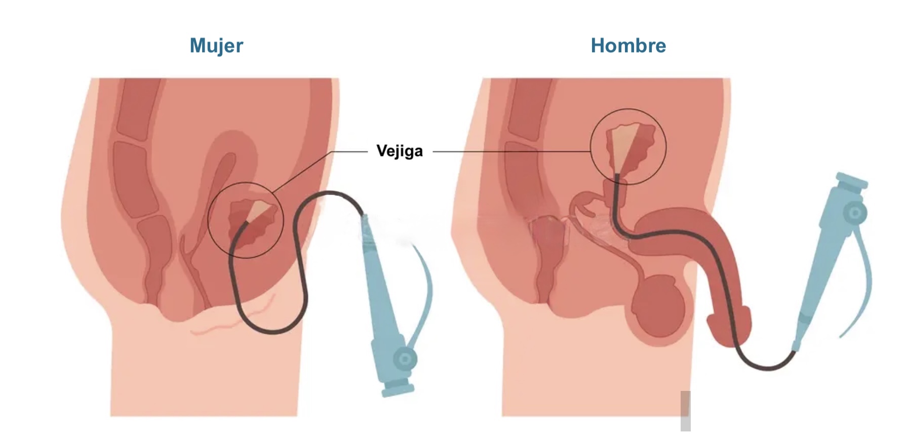 cistoscopía flexible de urgencia