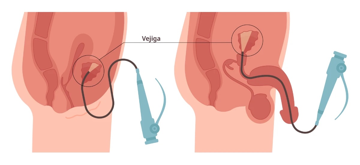 cistoscopía rígida en santiago