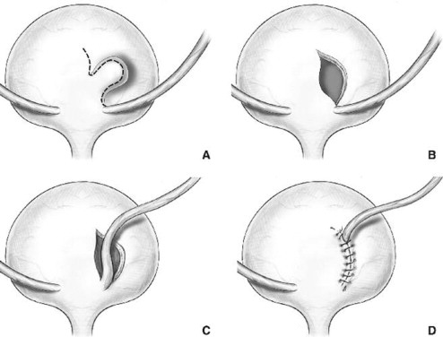 Divertículos Vesicales cirugía de urgencia