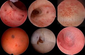 endoscopía y cistoscopía