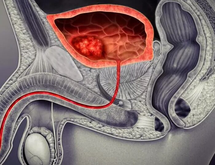 Lesiones uretrales diagnóstico de urgencia