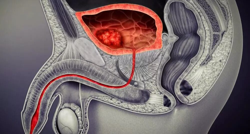 Lesiones uretrales diagnóstico de urgencia