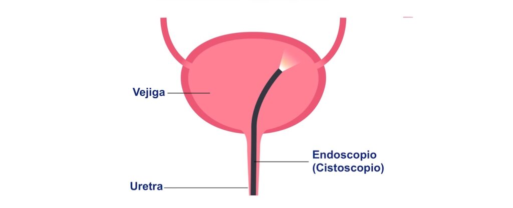 Videouretrocistoscopía de urgencia