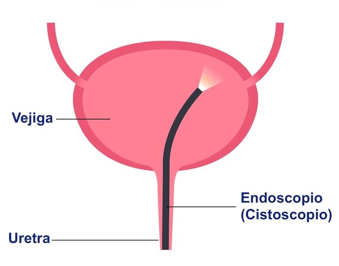Videouretrocistoscopía de urgencia