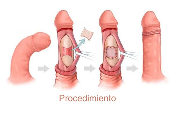 enfermedad de peyronie. cirugía para pene torcido