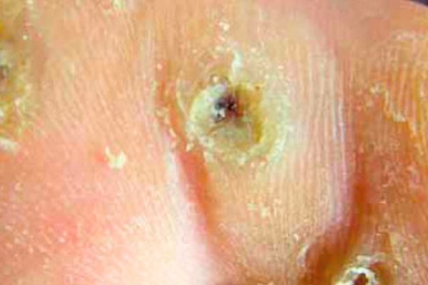 enfermedad de transmisón sexual