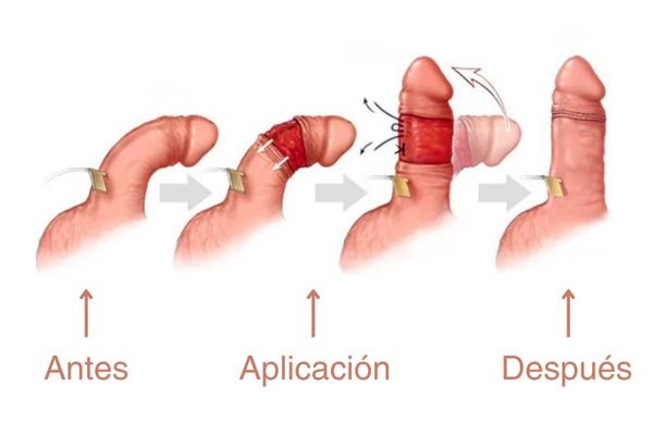 enfermedad de peyronie. cirugía para pene torcido