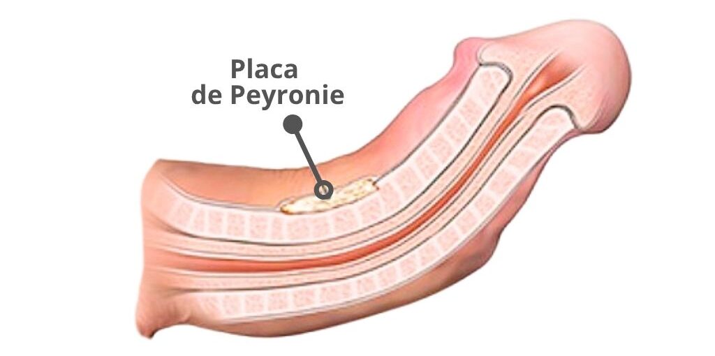 enfermedad de peyronie. tratamiento para pene torcido