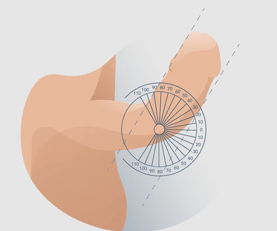 enfermedad de peyronie. solución para pene torcido