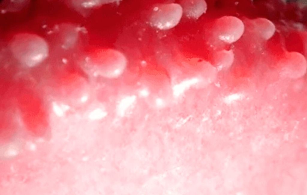 pápulas perladas y extracción con cirugía