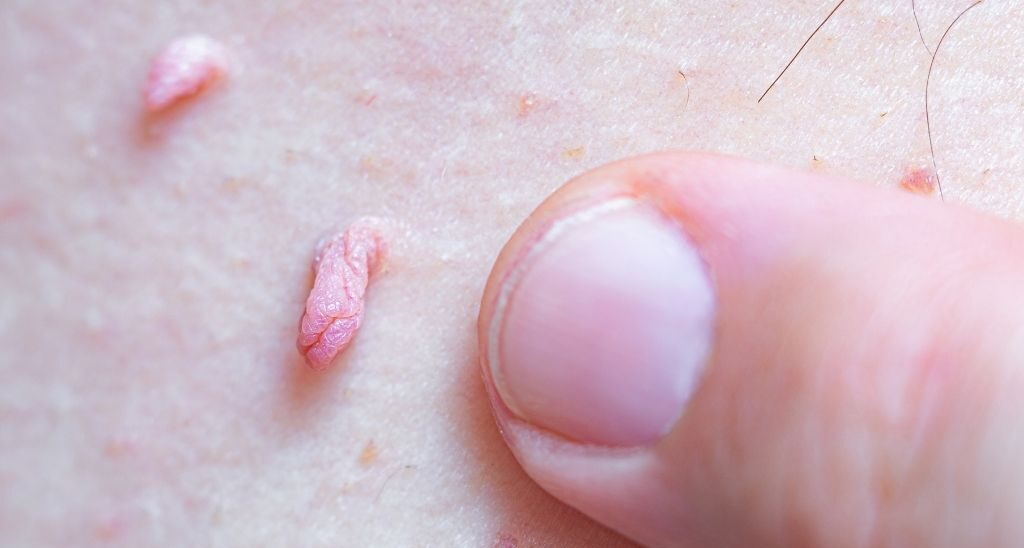 urólogo para sacar verrugas genitales