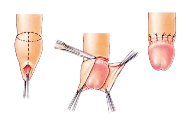 fimosis y cirugía de urgencia