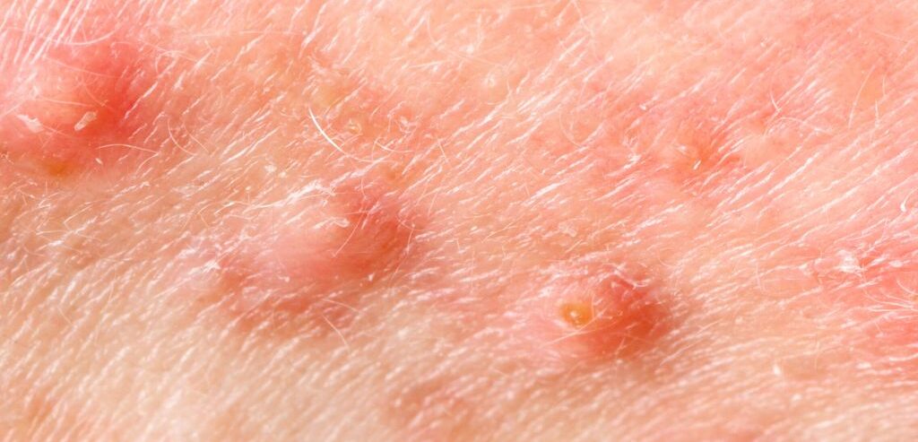 granitos en el pene, glande