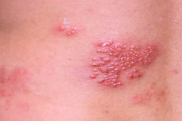 enfermedad íntima femenina