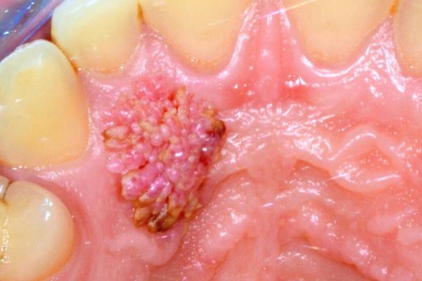 Papiloma en la boca