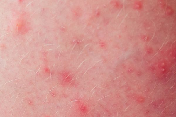 manchas y puntos rojos en el pene, tratamiento médico confidencial